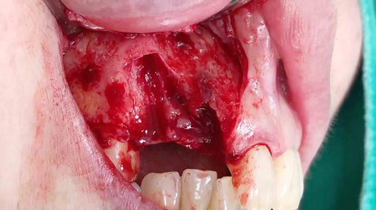 A surgical procedure using non resorbable membrane 2