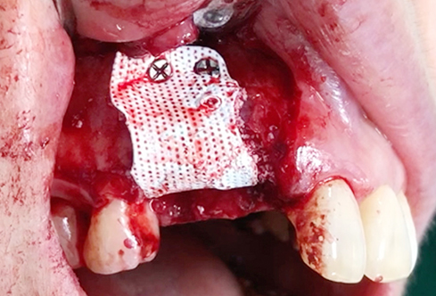 A surgical procedure using non resorbable membrane 3