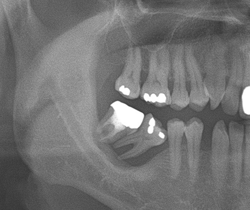 A clinical case using resorbable membrane 1