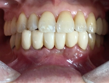 Another clinical case using  non resorbable membrane and bone tac 7