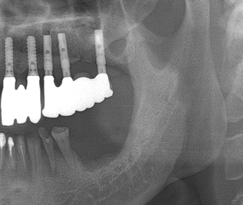 Another clinical case using  non resorbable membrane and bone tac 8