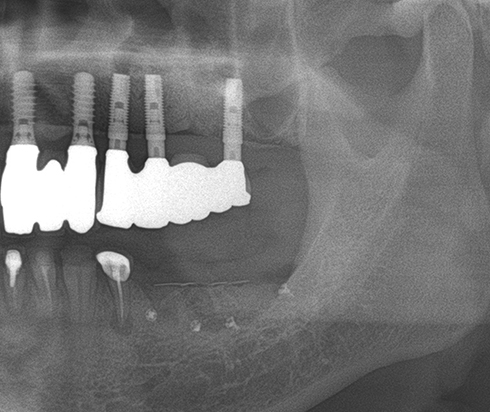 Another clinical case using  non resorbable membrane and bone tac 9