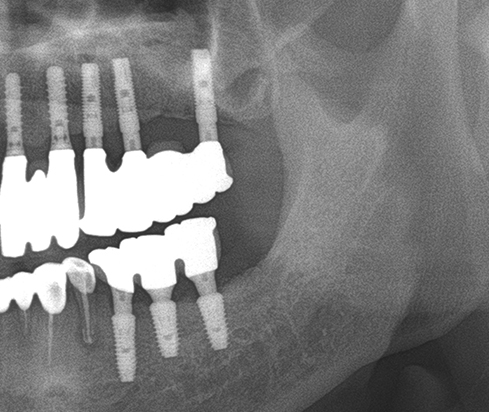 Another clinical case using  non resorbable membrane and bone tac 10