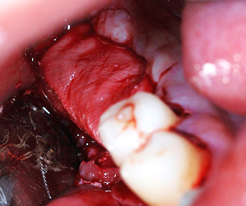 A clinical case using resorbable membrane 2