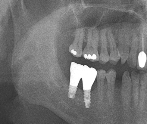 A clinical case using resorbable membrane 3