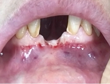 Another clinical case using  non resorbable membrane and bone tac 2