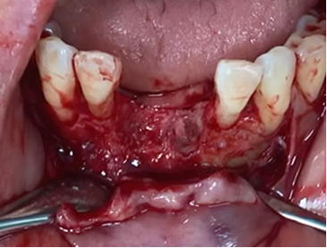 Another clinical case using  non resorbable membrane and bone tac 3