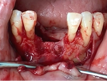 Another clinical case using  non resorbable membrane and bone tac 4