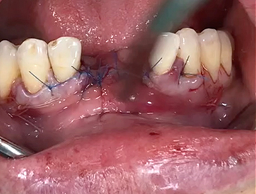 Another clinical case using  non resorbable membrane and bone tac 6